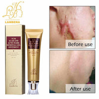 Original Acne Scar Removal Cream