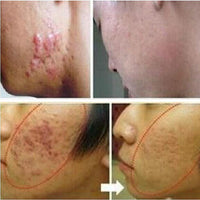 Original Acne Scar Removal Cream
