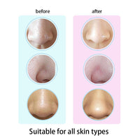 Blackhead Pore Vacuum Remover
